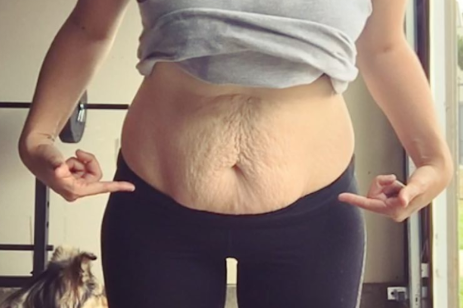 17 Women Share Pics Of Loose Skin After Weight Loss To Prove How Common And  Normal It Is | Self