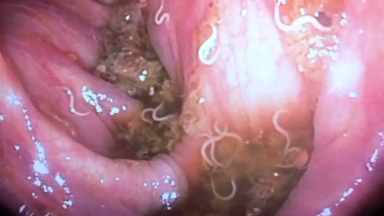 Pinworms Found On Colonoscopy - Youtube